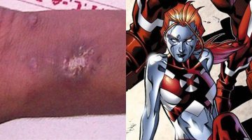 Adolescente injeta mercúrio na veia para ‘se tornar um herói da Marvel’