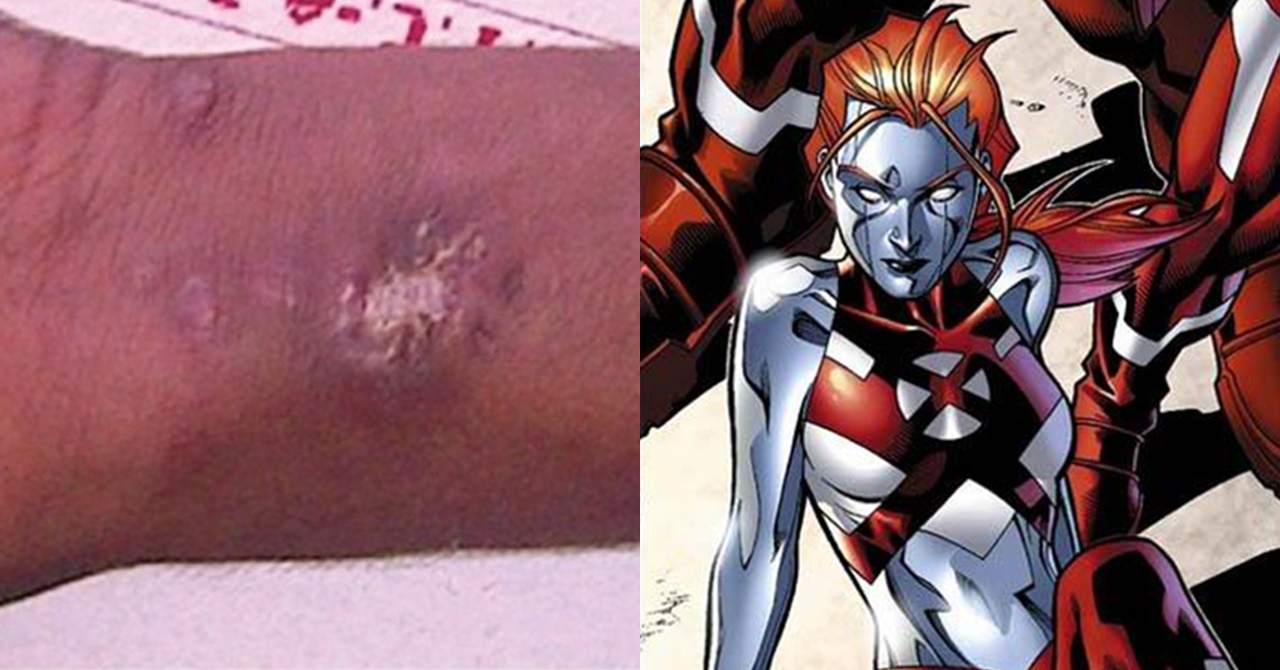 Adolescente injeta mercúrio na veia para ‘se tornar um herói da Marvel’